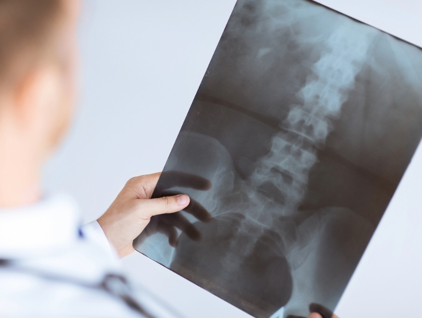 Understanding Spinal Cord Injury Claims In Personal Injury Law