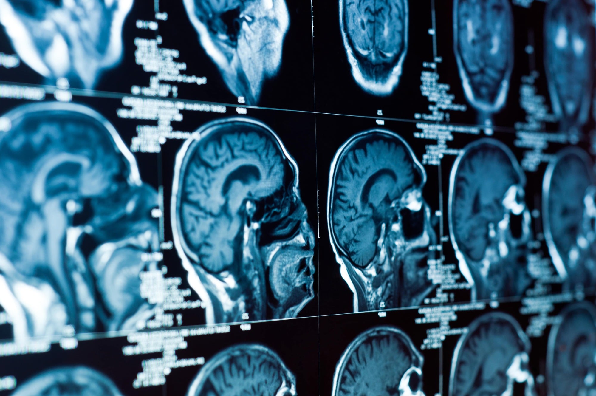 Brain Injury Lawyer Davie, FL